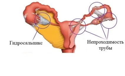 Що це таке гідросальпінкс зліва, як лікувати без операції (симптоми) Що це таке гідросальпінкс зліва, як лікувати без операції