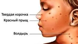Дитячі інфекції - вітряна віспа (віспа) Дитячі інфекції - вітряна віспа