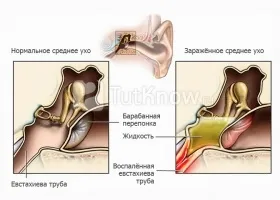 Дитячий ларингіт симптоми і лікування