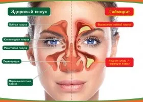 Дитячий ларингіт симптоми і лікування