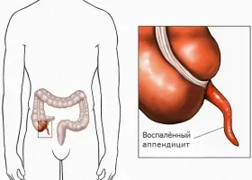 Дитячий ларингіт симптоми і лікування
