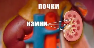 Дієта при фосфатних каменях в нирках - суть правильного харчування (нирках) Дієта при фосфатних каменях в нирках - суть правильного харчування