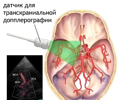 Доплерографія судин голови і шиї види УЗДГ, показання, що показує і як робиться (судин) Доплерографія судин голови і шиї види УЗДГ, показання, що показує і як робиться