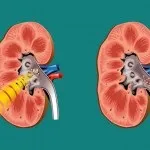 Дроблення каменів в нирках - лазерна та ультразвукова літотрипсія (дроблення каменів в нирках лазерна ультразвукова контактна дистанційна літотрипсія) Дроблення каменів в нирках - лазерна та ультразвукова літотрипсія