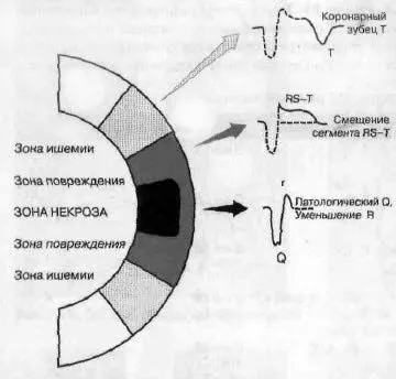 Електрокардіограма при гострому інфаркті міокарда (стеноз) Електрокардіограма при гострому інфаркті міокарда