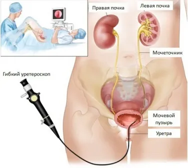 Дроблення каменів в нирках - лазерна та ультразвукова літотрипсія (лазерна) Дроблення каменів в нирках - лазерна та ультразвукова літотрипсія