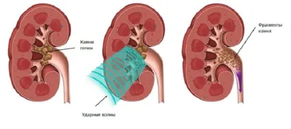 Дроблення каменів в нирках ультразвуком як видаляють (ультразвуком) Дроблення каменів в нирках ультразвуком як видаляють