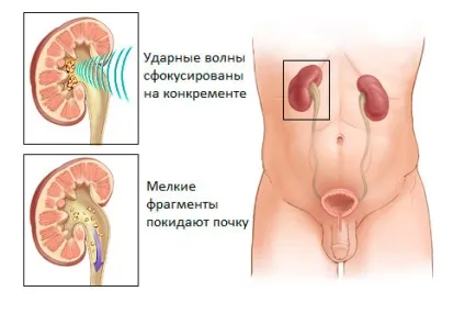 Дроблення каменів в нирках - лазерна та ультразвукова літотрипсія (ультразвукова) Дроблення каменів в нирках - лазерна та ультразвукова літотрипсія
