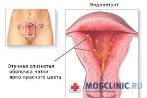 Ендометрит симптоми, лікування, наслідки (лікування ендометриту) Ендометрит симптоми, лікування, наслідки