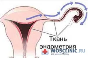 Ендометрит симптоми, лікування, наслідки (наслідки) Ендометрит симптоми, лікування, наслідки