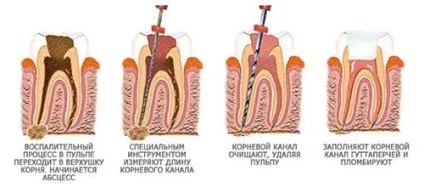 Ендодонтичне лікування зуба це, мікрооперація в кореневих каналах (лікування) Ендодонтичне лікування зуба це, мікрооперація в кореневих каналах