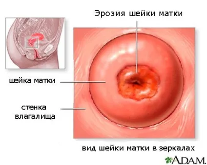 Ерозія шийки матки симптоми, причини, діагностика, наслідки (шийки) Ерозія шийки матки симптоми, причини, діагностика, наслідки