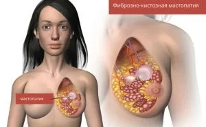 Фіброзна мастопатія молочної залози що це таке і як лікувати (фіброзна) Фіброзна мастопатія молочної залози що це таке і як лікувати