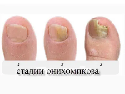 Флуконазол від грибка нігтів інструкція та відгуки (помітно змінює колір) Флуконазол від грибка нігтів інструкція та відгуки