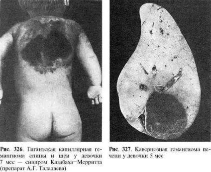 гемангіома спини