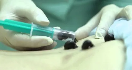 Гірудотерапія при цукровому діабеті користь і шкода, протипоказання, відгуки (шкода) Гірудотерапія при цукровому діабеті користь і шкода, протипоказання, відгуки