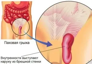 Грижа яєчка у дитини симптоми, причини, лікування захворювання