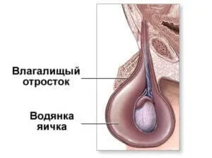 Грижа яєчка у дитини симптоми, причини, лікування захворювання