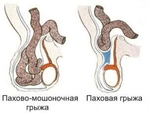Грижа яєчка у дитини симптоми, причини, лікування захворювання