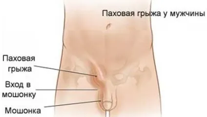 Грижа яєчка у чоловіків фото, як лікувати (грижа яєчка чоловіків) Грижа яєчка у чоловіків фото, як лікувати