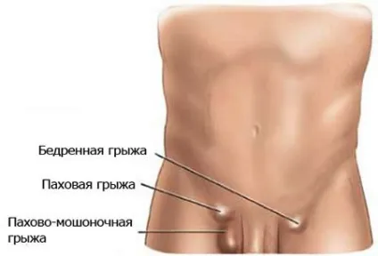Грижа яєчка у чоловіків фото, як лікувати (грижа) Грижа яєчка у чоловіків фото, як лікувати