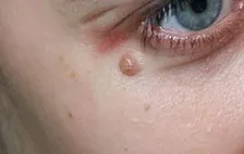 Папіломи на обличчі фото, причини, лікування, нарости на шкірі (особі) Папіломи на обличчі фото, причини, лікування, нарости на шкірі