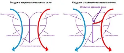 Відкрите овальне вікно в серце у дитини як лікувати