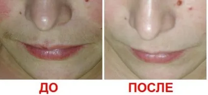Відгуки про фотоепіляції в домашніх умовах який апарат краще, відео-інструкція про видалення (відгуки про фотоепіляції в домашніх умовах) Відгуки про фотоепіляції в домашніх умовах який апарат краще, відео-інструкція про видалення