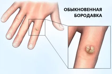 Папіломи у дітей, як лікувати новонародженої дитини видалення (дитини) Папіломи у дітей, як лікувати новонародженої дитини видалення