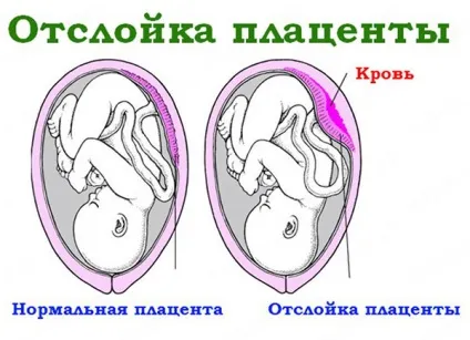 Відшарування плаценти - причини, діагностика, лікування (причини) Відшарування плаценти - причини, діагностика, лікування
