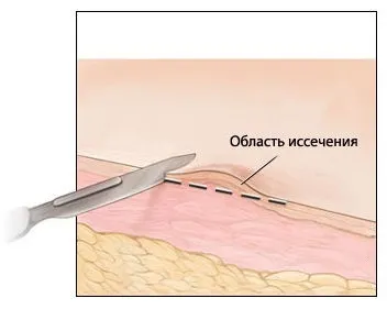 Дослідження біопсійного матеріалу опис, норми (Гистоморфологические верифікація діагнозу) Дослідження біопсійного матеріалу опис, норми