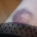 Як швидко позбутися від синяка, щоб не залишилося і сліду (які допоможуть швидко) Як швидко позбутися від синяка, щоб не залишилося і сліду