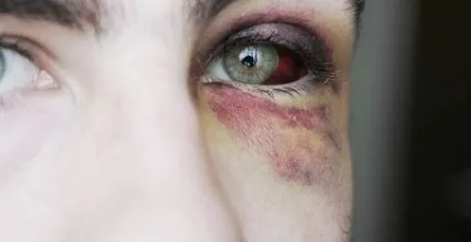 Як швидко позбутися від синяка, щоб не залишилося і сліду (які допоможуть швидко позбутися) Як швидко позбутися від синяка, щоб не залишилося і сліду