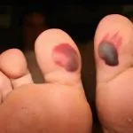 Як позбавиться від потрісканих ступень в домашніх умовах, все про ногах