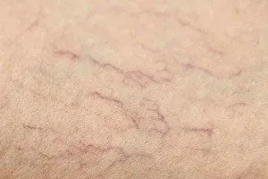 Як позбутися від судинної сітки на ногах (судинної) Як позбутися від судинної сітки на ногах