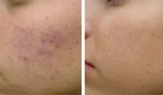 Як позбутися від прищів і жирної шкіри мій досвід (прищів) Як позбутися від прищів і жирної шкіри мій досвід