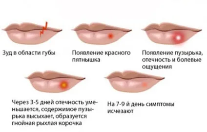 Як позбутися від застуди на губі швидко в домашніх умовах (ацикловір) Як позбутися від застуди на губі швидко в домашніх умовах