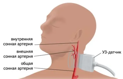 Триплексне сканування судин шиї та головного мозку 1 (новоутворення на тілі людини) Триплексне сканування судин шиї та головного мозку 1