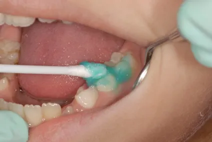 Тус мус - ремінералізующій гель для зубів (gc tooth mousse) інструкція із застосування, для дітей (зубів) Тус мус - ремінералізующій гель для зубів (gc tooth mousse) інструкція із застосування, для дітей