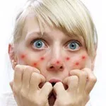 Як прибрати почервоніння від прищів на обличчі швидко за 5 хвилин, за ніч (особі) Як прибрати почервоніння від прищів на обличчі швидко за 5 хвилин, за ніч