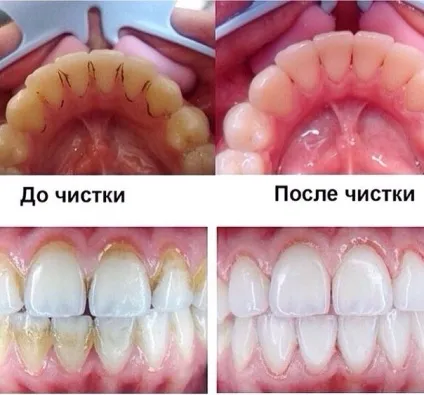 Як прибрати наліт з зубів від сигарет в домашніх умовах, народні засоби (прибрати) Як прибрати наліт з зубів від сигарет в домашніх умовах, народні засоби