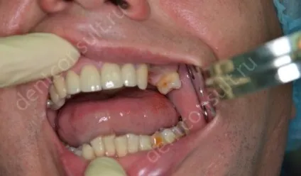 Як відновлювати зуб після видалення, огляд методів! (Як відновлювати зуб після видалення) Як відновлювати зуб після видалення, огляд методів!