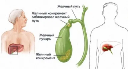 Калькульознийхолецистит лікування народними засобами