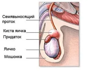 Кіста яєчка у чоловіків (сперматоцеле) симптоми, лікування і наслідки