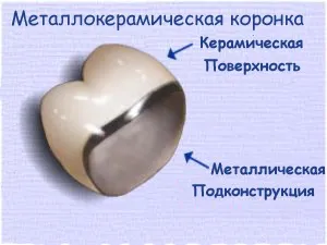 Коронки на зуби які краще, ціна, вартість установки на один зуб, які ставити на жувальні (зуби) Коронки на зуби які краще, ціна, вартість установки на один зуб, які ставити на жувальні