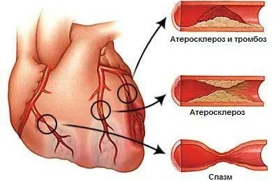 Коронарне стентування судин серця реабілітація, скільки живуть, дієта і фізичні навантаження, (стентування) Коронарне стентування судин серця реабілітація, скільки живуть, дієта і фізичні навантаження,