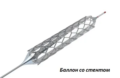 Коронарне стентування судин серця реабілітація, скільки живуть, дієта і фізичні навантаження, (судин) Коронарне стентування судин серця реабілітація, скільки живуть, дієта і фізичні навантаження,