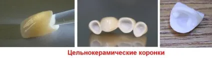 Коронки на зуби які краще, ціна, вартість установки на один зуб, які ставити на жувальні (які) Коронки на зуби які краще, ціна, вартість установки на один зуб, які ставити на жувальні