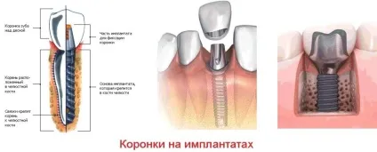 Коронки на зуби які краще, ціна, вартість установки на один зуб, які ставити на жувальні (ціна) Коронки на зуби які краще, ціна, вартість установки на один зуб, які ставити на жувальні