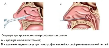 Конхотомія носових раковин що це таке, лазерна конхотомія, операція (операція) Конхотомія носових раковин що це таке, лазерна конхотомія, операція